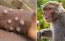 نشانه‌های ابتلا به «آبله میمون» / بررسی اثربخشی واکسن «آبله»