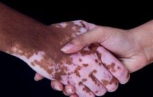 آغاز درمان یک بیماری مادرزادی با سلول‌های بنیادی در شیراز