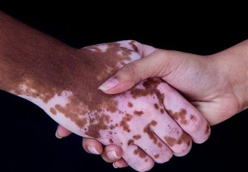 آغاز درمان یک بیماری مادرزادی با سلول‌های بنیادی در شیراز
